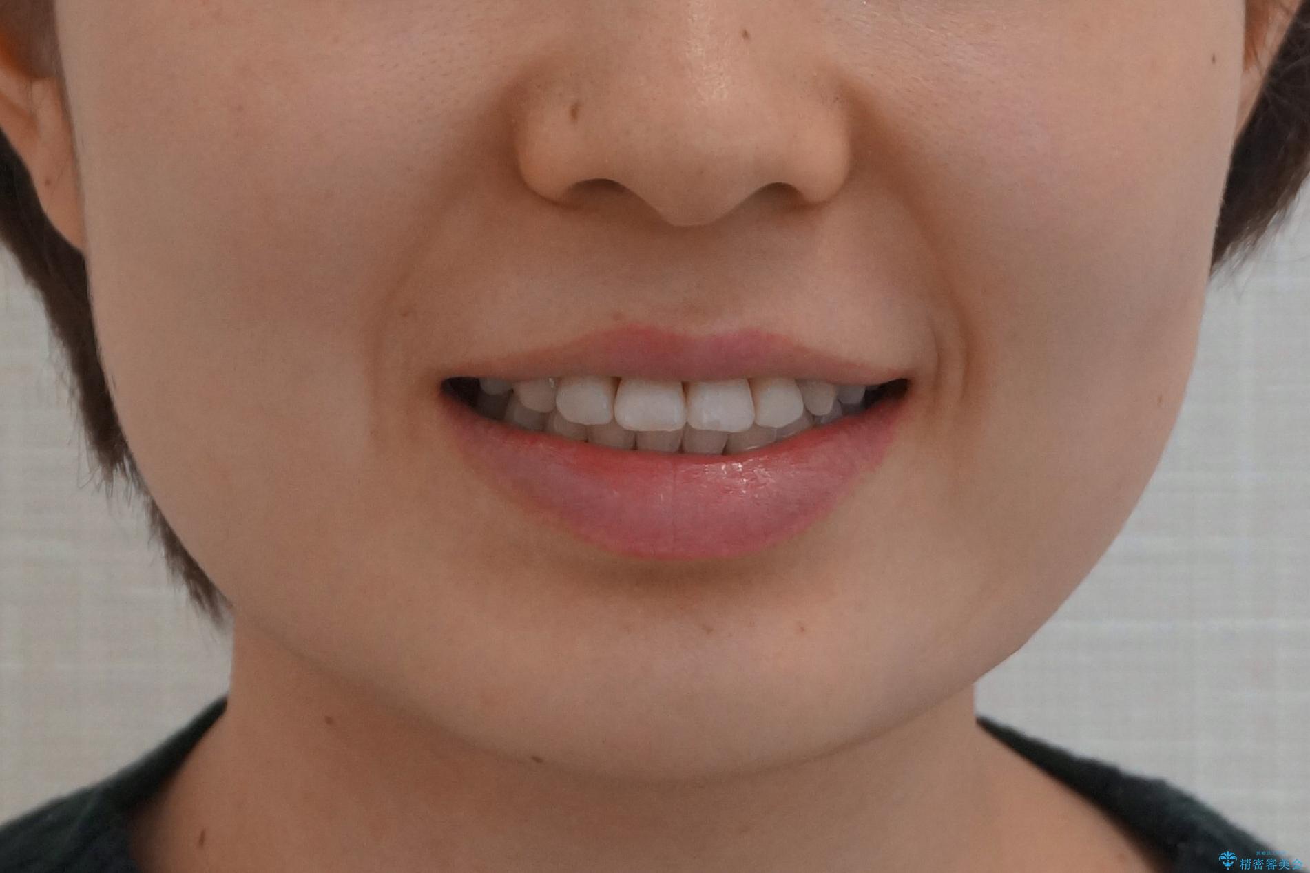受け口の改善 歯を抜かずに矯正の治療後(顔貌)