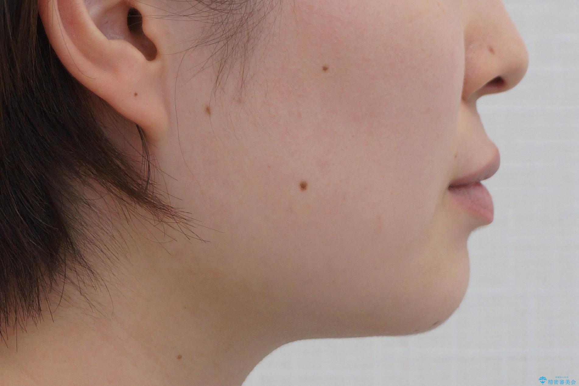 受け口の改善 歯を抜かずに矯正の治療後(顔貌)