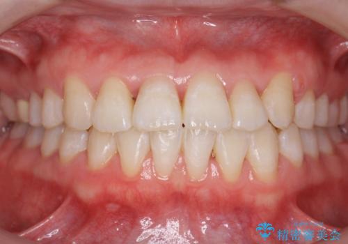 受け口の改善　歯を抜かずに矯正の症例 治療後