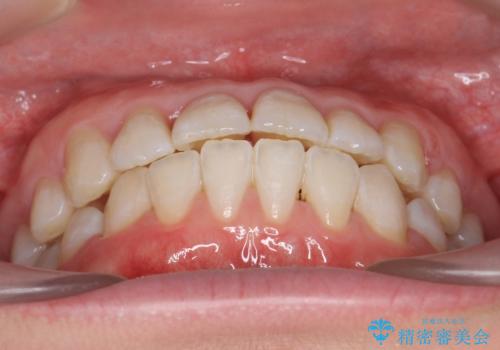 受け口の改善 歯を抜かずに矯正の治療後