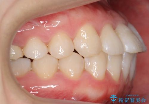 受け口の改善 歯を抜かずに矯正の治療後