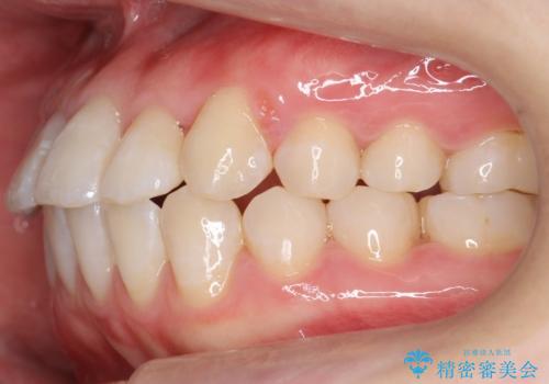 受け口の改善 歯を抜かずに矯正の治療後