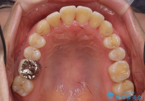 受け口の改善 歯を抜かずに矯正の治療後