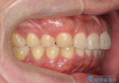 前歯のねじれを 1年かけずに矯正 インビザラインの治療後