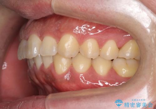 前歯のねじれを 1年かけずに矯正 インビザラインの治療後