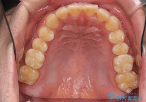 前歯のねじれを 1年かけずに矯正 インビザラインの治療後