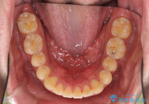 前歯のねじれを 1年かけずに矯正 インビザラインの治療後