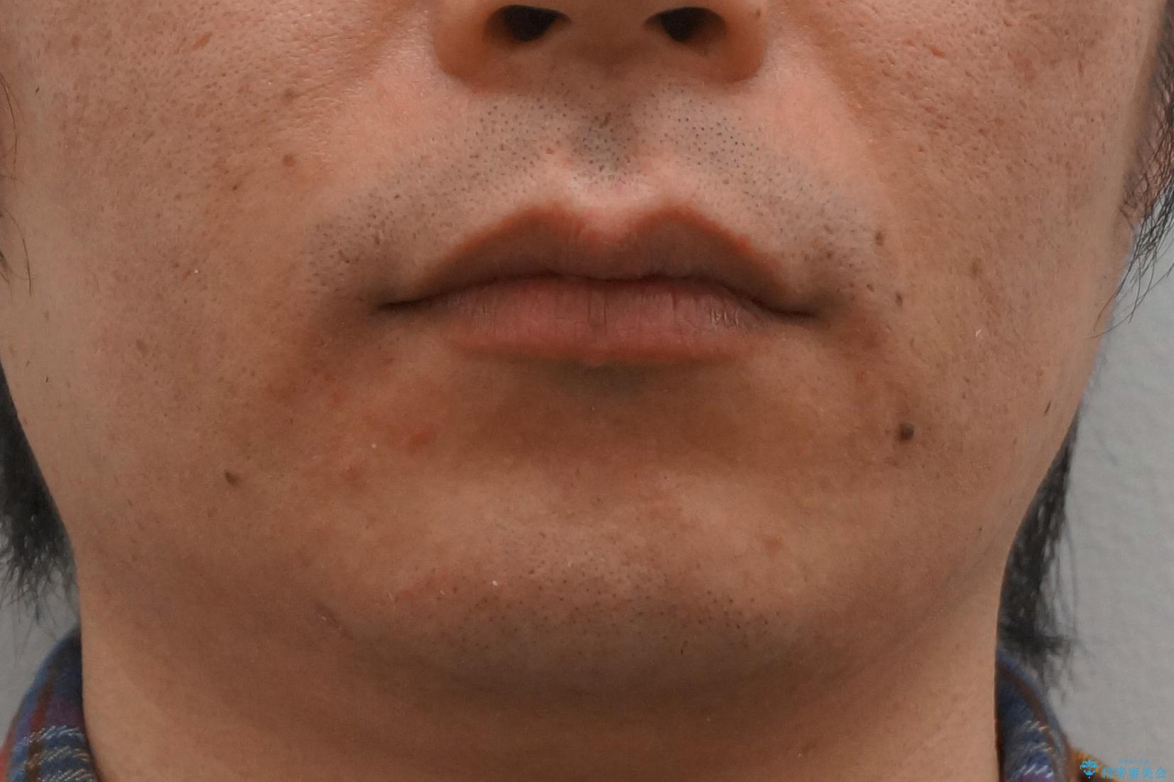 前歯のねじれを 1年かけずに矯正 インビザラインの治療後(顔貌)