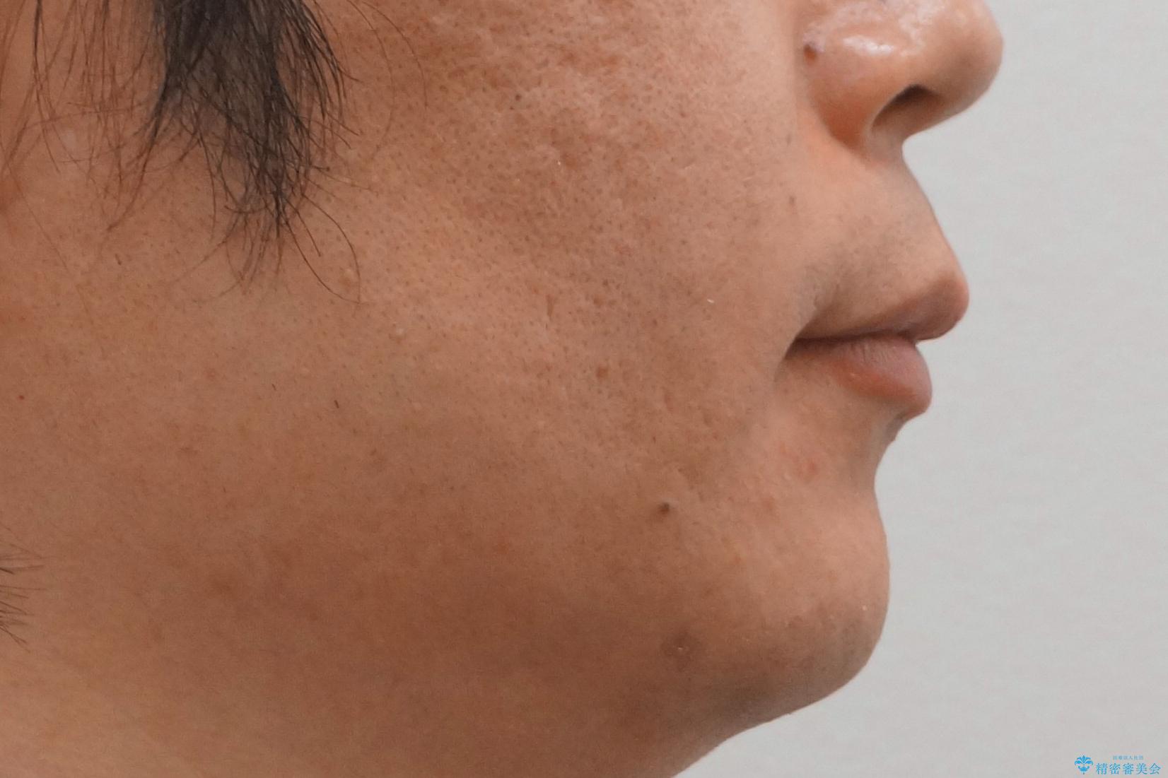 前歯のねじれを 1年かけずに矯正 インビザラインの治療後(顔貌)