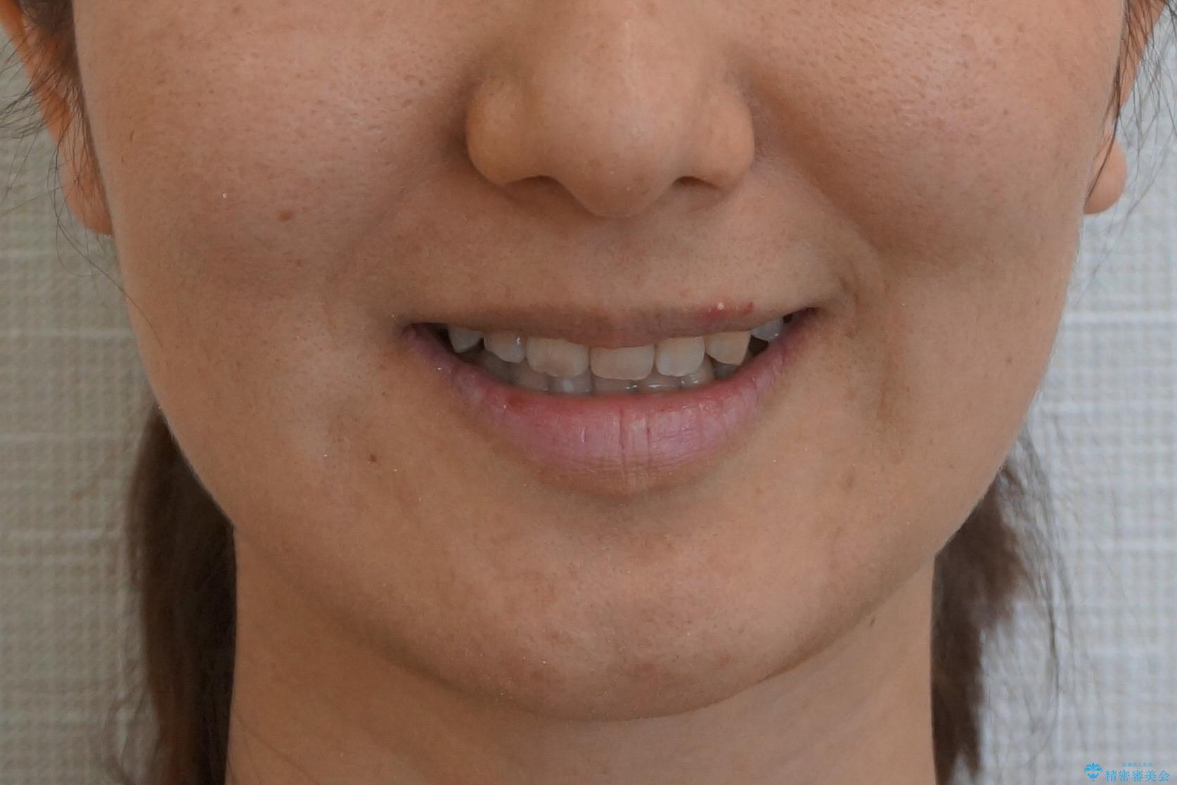 30代女性　残った乳歯を抜いてスペースを閉じる矯正　前歯のねじれの治療後（顔貌）