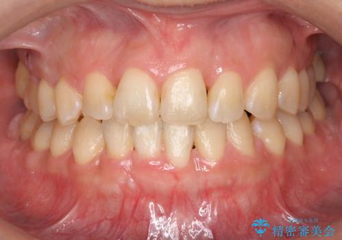 30代女性 残った乳歯を抜いてスペースを閉じる矯正 前歯のねじれの症例 治療後