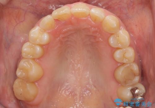 30代女性 残った乳歯を抜いてスペースを閉じる矯正 前歯のねじれの治療後