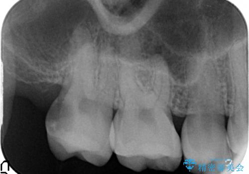 オールセラミッククラウン 他院にて抜歯と言われた歯の治療の治療前