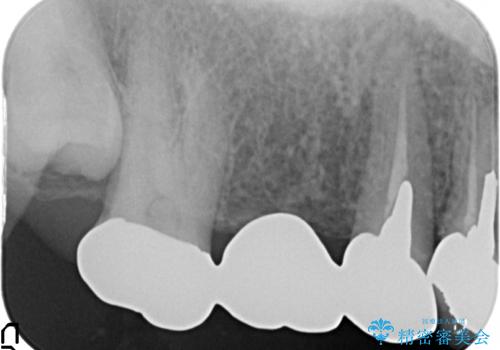 インプラント(ストローマン) 抜歯後の欠損補綴の治療前