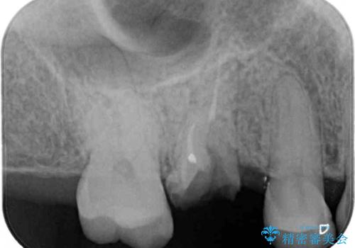 抜歯になった虫歯 奥歯のインプラント治療の治療前