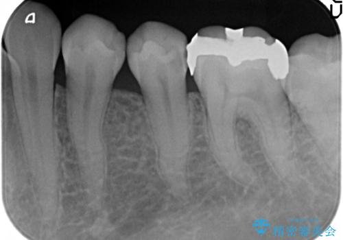 セラミックインレー　他院にて歯の神経治療が必要と言われた虫歯の治療前