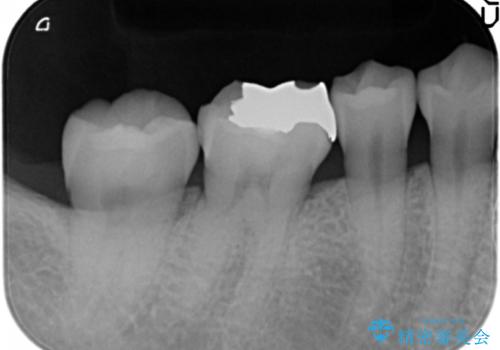 銀歯を白く セラミックインレーにの治療前