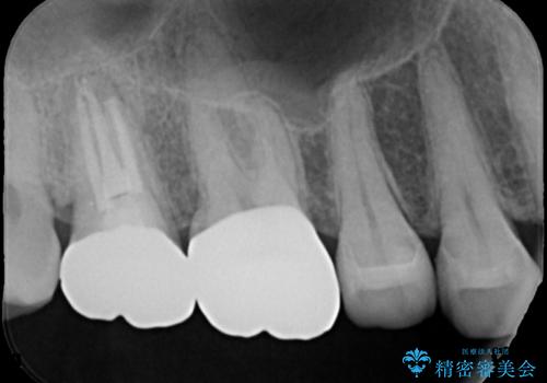 [フルジルコニアクラウン] 老朽化した銀歯を白くの治療後