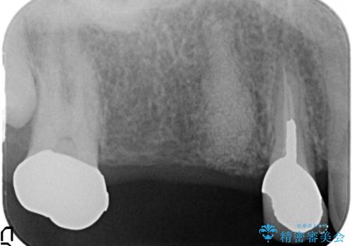 インプラント(ストローマン)　抜歯後の欠損補綴の治療前