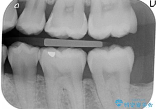 奥歯の虫歯 セラミックインレーにの治療前