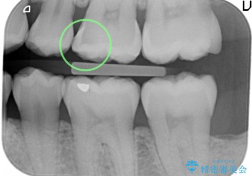 奥歯の虫歯 セラミックインレーにの治療前