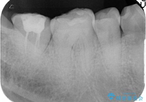 歯ぎしりによる異常に低い歯冠高径 　歯周外科による解決の治療前