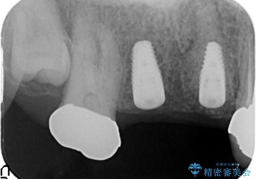 インプラント(ストローマン)　抜歯後の欠損補綴の治療後