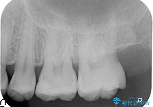 奥歯の虫歯 セラミックインレーにの治療後
