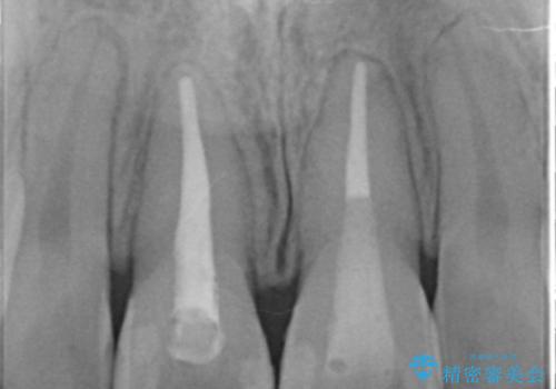 前歯の変色 セラミックで ホワイトニングも併用の治療前