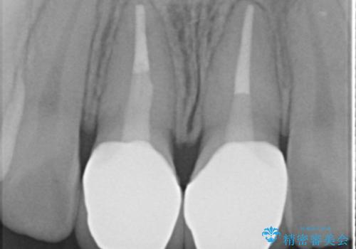 前歯の変色 セラミックで ホワイトニングも併用の治療後