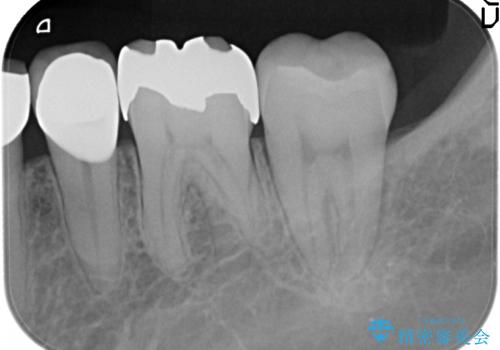 臼歯部　長期的に予知性の高いゴールドインレーへの治療前