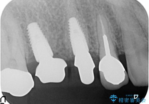 インプラント(ストローマン) 抜歯後の欠損補綴の治療中