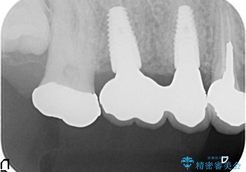 インプラント(ストローマン) 抜歯後の欠損補綴の治療後