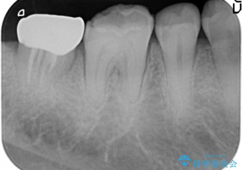 歯ぎしりによる異常に低い歯冠高径 　歯周外科による解決の治療後
