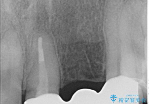 オールセラミッククラウン 前歯のブリッジ 気になる見た目の改善の治療後
