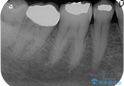 オールセラミッククラウン　被せ物が外れたの治療後