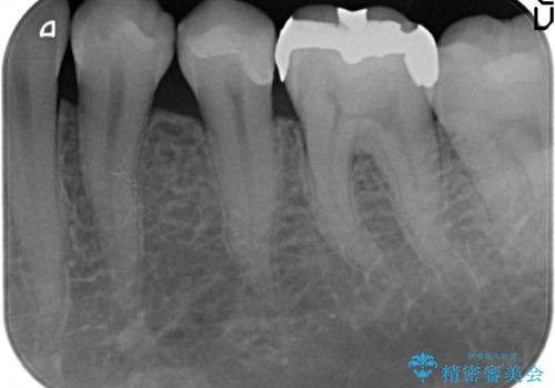 セラミックインレー　他院にて歯の神経治療が必要と言われた虫歯の治療後