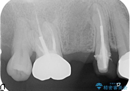 オールセラミッククラウン 治療途中の歯の補綴の治療前