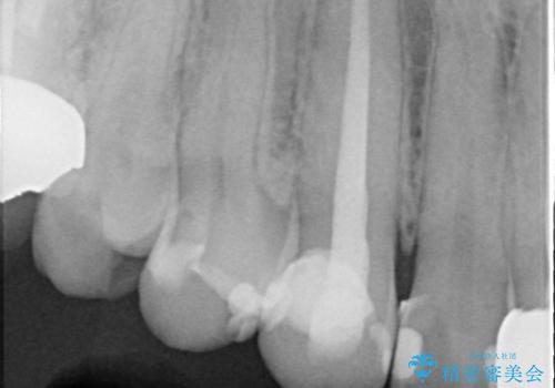 オールセラミッククラウン　根管治療後の補綴の治療前