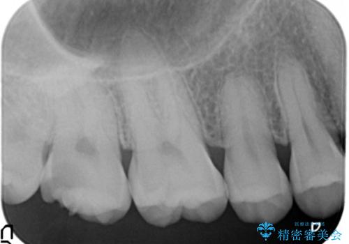 深い虫歯 丁寧にう蝕を除去し神経を保存 30代男性の治療前