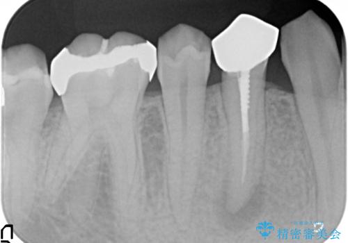 オールセラミッククラウン 咬むと痛む歯の根管治療~補綴の治療前
