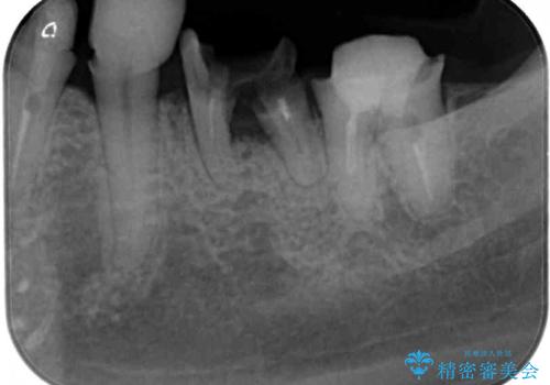 歯の欠損を放置　オールセラミックブリッジによる補綴治療の治療前
