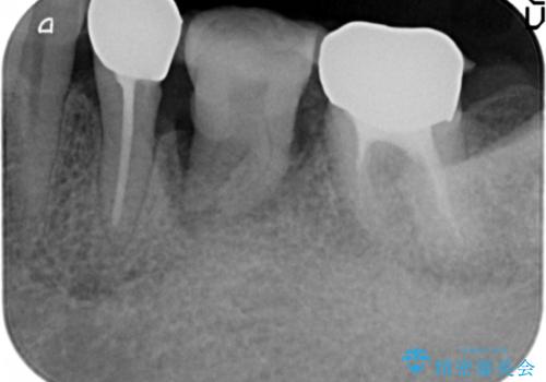親知らずの移植 70代男性の治療中