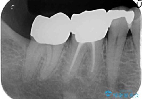 下の奥歯の虫歯　歯周外科手術を含めた治療の治療後