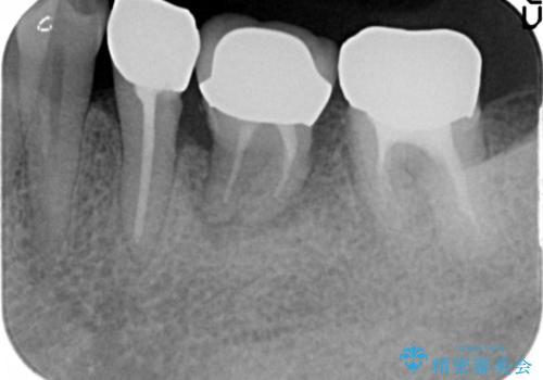 親知らずの移植 70代男性の治療後