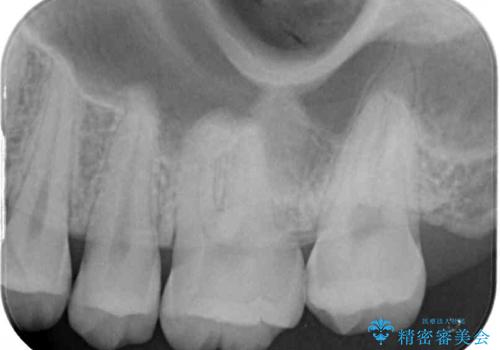 奥歯の虫歯　ゴールドインレーによる修復治療の治療前