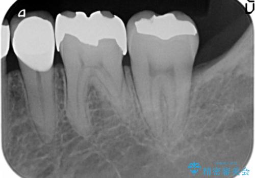 臼歯部　長期的に予知性の高いゴールドインレーへの治療後