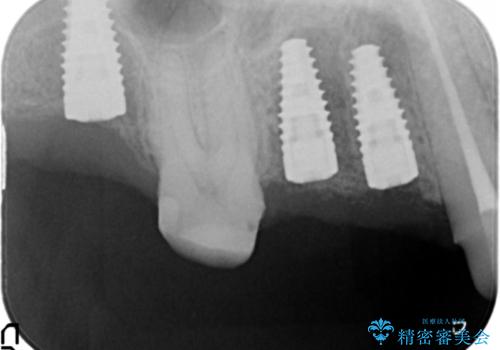 [強すぎる咬合力]　破折歯のインプラントによる咬合機能回復治療の治療中