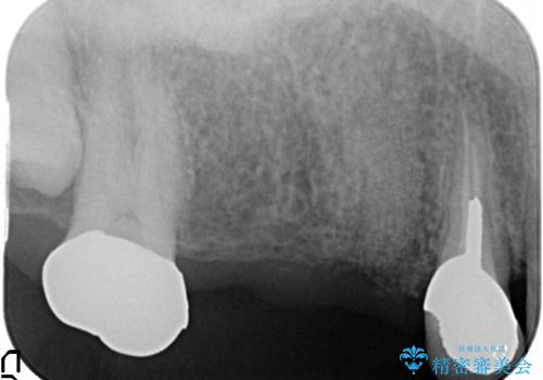 インプラント(ストローマン)　抜歯後の欠損補綴の治療後