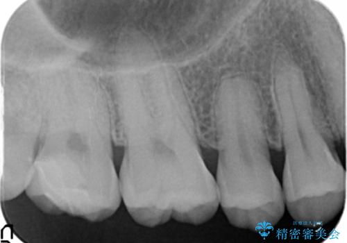 深い虫歯 丁寧にう蝕を除去し神経を保存 30代男性の治療後